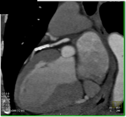 Stent in LAD - CTisus CT Scan