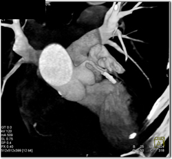 Stent in LAD - CTisus CT Scan