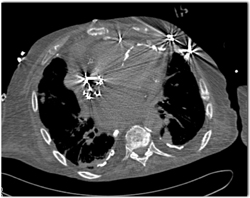 Left Ventricular Assist Device - CTisus CT Scan