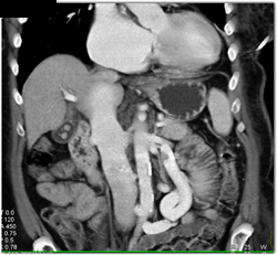 Poor Cardiac Function With IVC Reflux - CTisus CT Scan