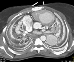 Congenital Heart Disease With Stenosis of Right Pulmonary Artery and Dilated Left Pulmonary Artery - CTisus CT Scan