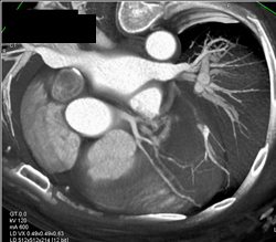 Normal Coronary Anatomy - CTisus CT Scan