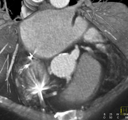 Aneurysm of Left Main Coronary Artery - CTisus CT Scan