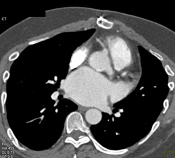 Small RCA - CTisus CT Scan