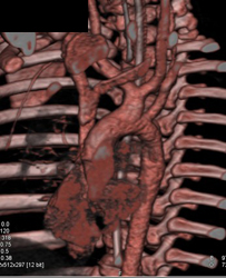 Bovine Arch - CTisus CT Scan