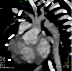 Coarctation of the Aorta - CTisus CT Scan