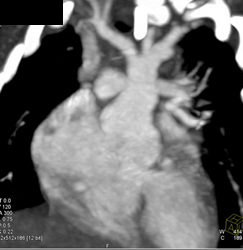 Coarctation of the Aorta - CTisus CT Scan