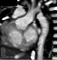 Coarctation of the Aorta - CTisus CT Scan