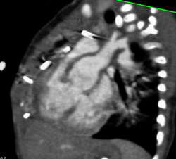 Coarctation of the Aorta - CTisus CT Scan