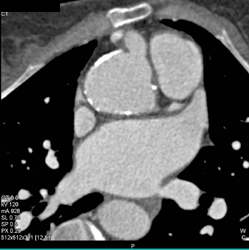 Dilated RCA - CTisus CT Scan