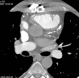 Poor Cardiac Function - CTisus CT Scan