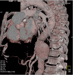 Thoracic Aorta Aneurysm - CTisus CT Scan