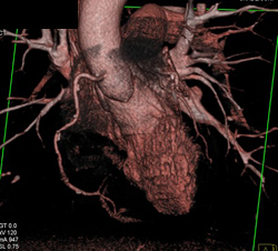 Plaque RCA With Significant Stenosis - CTisus CT Scan