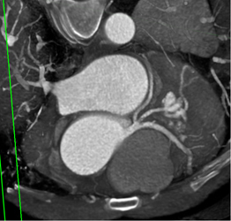 Trifurcation of the Left Main Coronary Artery - CTisus CT Scan