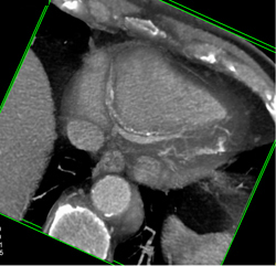 Diseased RCA and LAD - CTisus CT Scan