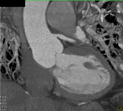 RCA Stenosis Is A Pseudo-lesion - CTisus CT Scan