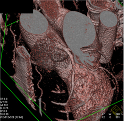 Normal LAD - CTisus CT Scan