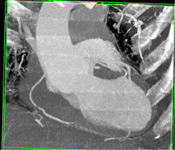 Normal RCA With Pseudo-lesions - CTisus CT Scan