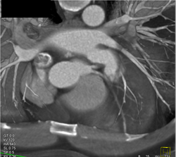 LAD and Circumflex Artery (CX) Arise Separately Off Left Cusp - CTisus CT Scan