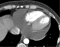 Pericardial Effusion - CTisus CT Scan