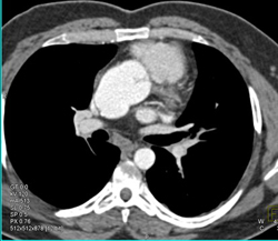 Dilated Aortic Root - CTisus CT Scan