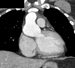 Dilated Aortic Root - CTisus CT Scan