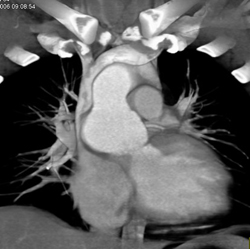 Dilated Aortic Root - CTisus CT Scan