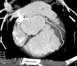 Normal LAD - CTisus CT Scan