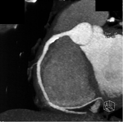 Minimal Plaque RCA - CTisus CT Scan