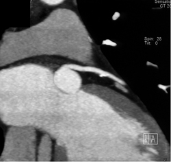 Calcified Plaque LAD W/o Significant Stenosis - CTisus CT Scan