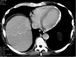 High Density Myocardium Due to CRF - CTisus CT Scan