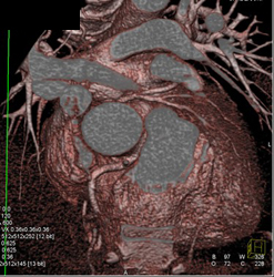 Left Main Coronary Artery Arises Off Right Cusp - CTisus CT Scan