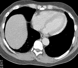 High Density Myocardium - CTisus CT Scan