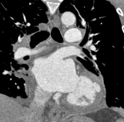 Outpouching of Left Ventricle - CTisus CT Scan