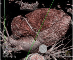 Normal LAD - CTisus CT Scan