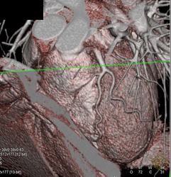 Normal LAD - CTisus CT Scan