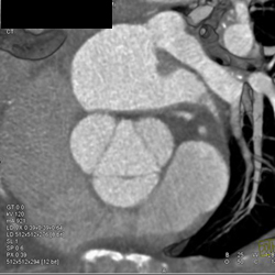 Normal Aortic Valve - CTisus CT Scan