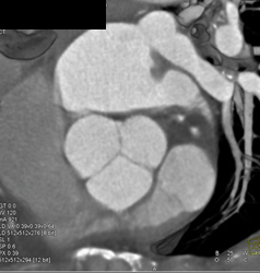 Normal Aortic Valve - CTisus CT Scan