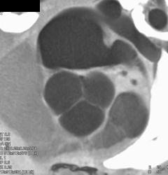 Normal Aortic Valve - CTisus CT Scan