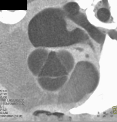 Normal Aortic Valve - CTisus CT Scan