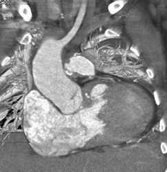 Patent Stents in Pulmonary Arteries in Patient With Hx of Tof - CTisus CT Scan