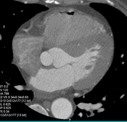 Air in Rv - CTisus CT Scan