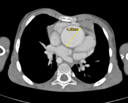 Dilated Aortic Root - CTisus CT Scan