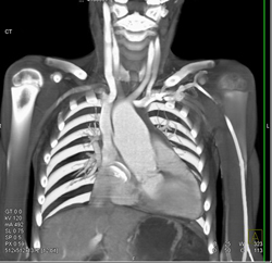 Dilated Aortic Root - CTisus CT Scan