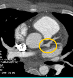 Left Coronary Aneurysm - CTisus CT Scan