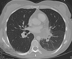 Lung Cancer Invades the Left Atrium and Pulmonary Vein - CTisus CT Scan