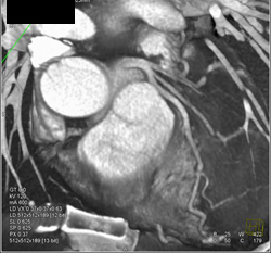 Normal LAD - CTisus CT Scan