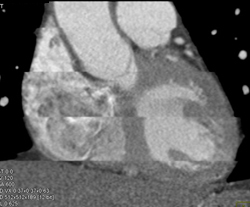 Step Off Due to Arrythmia - CTisus CT Scan