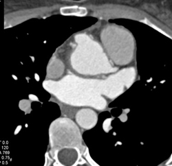 Button Anastomosis of Reimplanted Coronary Artery - CTisus CT Scan