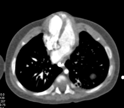 Pentalogy of Cantrell- Note Abdominal Wall Defect and Heart Extending Through Defect and Pulmonary Artery Stenosis - CTisus CT Scan